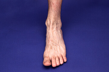 a man foot with a mesh of dilated varicose veins stands on a blue background