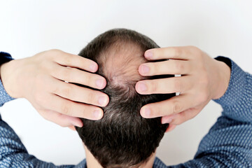 Baldness, man in a shirt concerned about hair loss. Male head with a bald