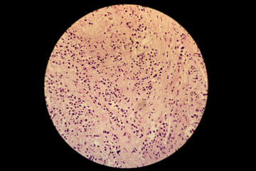 Microscopic slide of lung tumour adenocarcinoma 