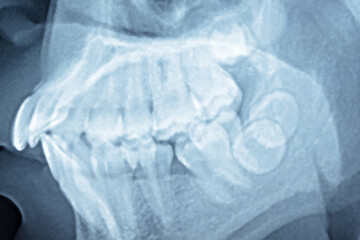 panoramic dental x-ray of a mouth.