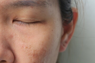 Large pore and blemish asian skin