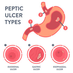 Peptic ulcer stomach disease infographic poster. Endoscopic image of stomach with duodenal, gastric and esophageal PUD. Digestive tract disorder. Health care and medical concept. Vector illustration. 