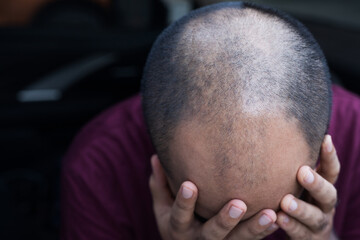 Close up man head of hair loss