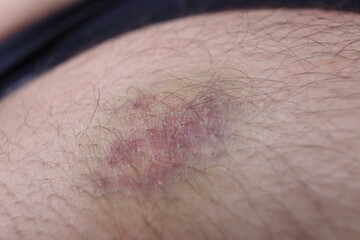 bruise on the skin