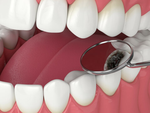 3d render of jaw with dental mirror