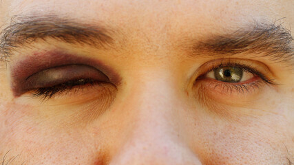 Black eye.