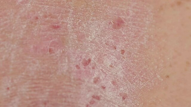 the area of the skin of the back of a person affected by psoriasis wounds plaques rashes