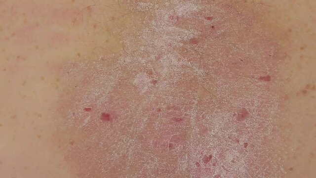 a person scratches psoriatic rashes on his back with his hand