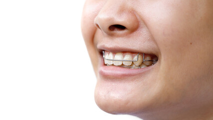 Smiling girl, close up photo showing for tooth retainer and oral hygiene