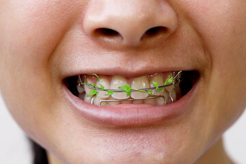 Vines on the teeth retainer. Meaning to maintain cleanliness during teeth braces.