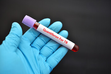 Obraz premium Test tube with blood sample for Quantiferon test, diagnosis for mycobacterium tuberculosis infection
