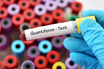 Test tube with blood sample for Quantiferon test, diagnosis for mycobacterium tuberculosis infection