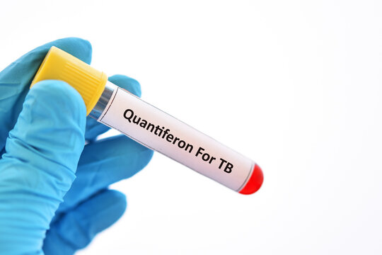 Test tube with blood sample for Quantiferon test, diagnosis for mycobacterium tuberculosis infection