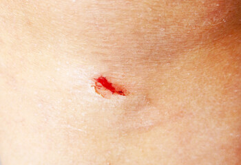 Small wound on the knee
