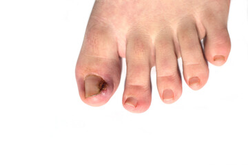Foot with ingrown toenail isolated on white. Sore and swollen toe closeup