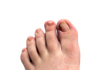 Foot with ingrown toenail isolated on white. Sore and swollen toe closeup