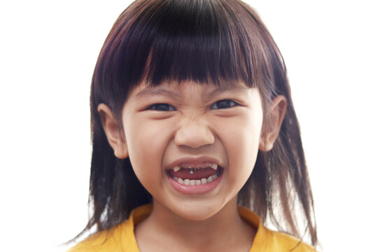 Asian little girl showing her open mouth full of caries teeth decay. Dental medicine and healthcare. caries from an early age