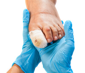 Bandaged injured toenail
