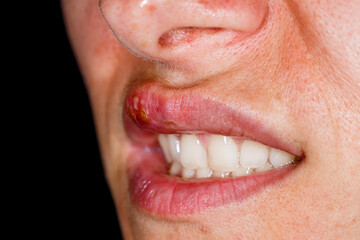 Oral herpes simplex virus infection