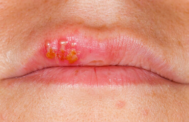 Oral herpes simplex virus infection