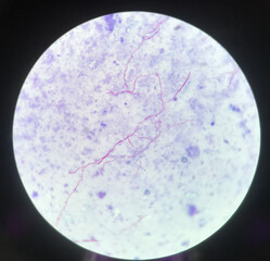 Red branching mycobacterium tuberculosis on blue background in modified acid fast bacilli stain.