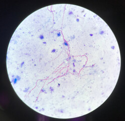 Red branching mycobacterium tuberculosis on blue background in modified acid fast bacilli stain.