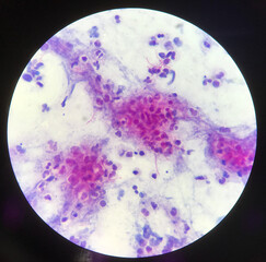 Red branching mycobacterium tuberculosis on blue background in modified acid fast bacilli stain.