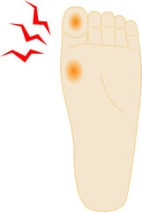 タコ　痛い　足のイラスト