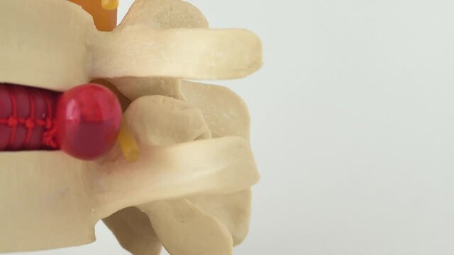 Doctor neurologist holds a mock spine with intervertebral hernia. Spine disease concept and sequestered or median hernia, spinal segment, osteochondrosis, copy space