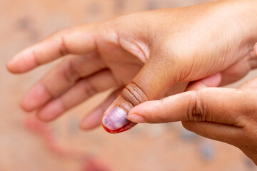 Injury to the right hand nail and bleeding to the right thumb And causing bleeding in the fingernail