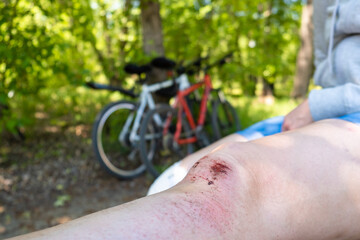 Damage to the legs during outdoor activities in the summer, cycling. An open bleeding wound on the...