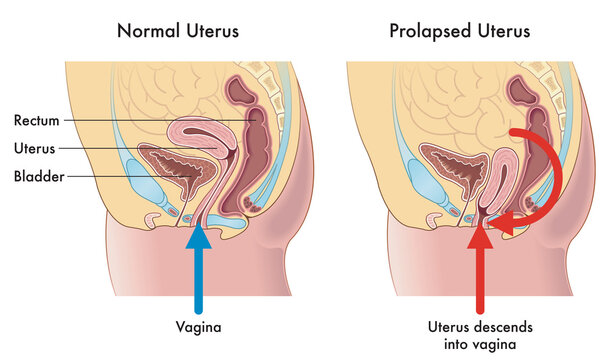 Medical illustration showing the difference between a normal uterus and a prolapsed uterus with annotations explaining how this occurs.