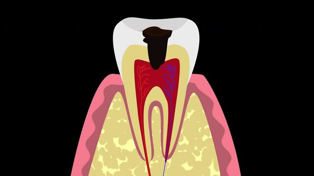 Tooth decay, dental caries and inflammation of the nerve of the tooth, pulpitis, 4K alpha channel