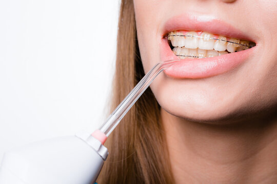 A girl with braces on her teeth pulls her lower lip with an irrigator to thoroughly rinse her mouth