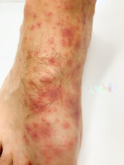 Close up of male's foot and toes with red rash desease on a white background.