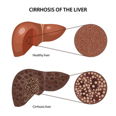 Cirrhosis of the liver. Histology of the healthy and cirrhotic liver with corresponding labels. Anatomical vector illustration in flat style isolated over white background.