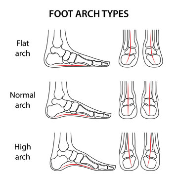 Orthopedics. Foot arch types. Flatfoot. Difference between sick and healthy feet. Vector illustration in outline style isolated on white background.
