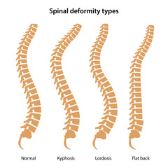 Spinal deformity types. Lateral view of human spines. Medical vector illustration in flat style is isolated on white background
