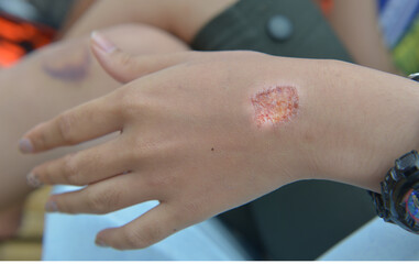 Abrasion Wound  dressing wound .