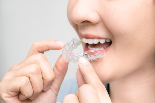 asian woman holding an invisalign braces or invisible retainer, orthodontic equipment, tooth whitening systems. teeth with whitening tray., Transparent braces.