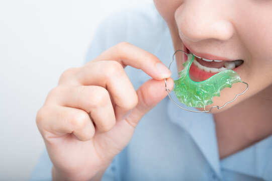 Asian woman wareing orthodontic retainers.Teeth retaining tools after braces .