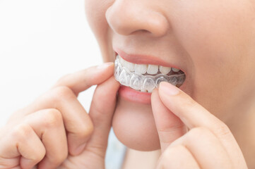 Woman wearing orthodontic silicone trainer. Mobile orthodontic appliance for dental correction....