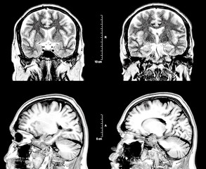 MRI Magnetic resonance image of the human brain and head