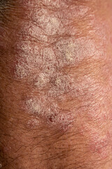 Psoriasis is a Chronic, inflammatory autoinmune skin disease