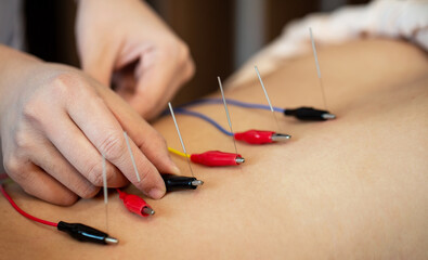 Electro-Acupuncture.Traditional Chinese acupuncture and Electro acupuncture on body of patient