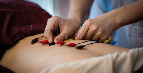 Electro-Acupuncture.Traditional Chinese acupuncture and Electro acupuncture on body of patient