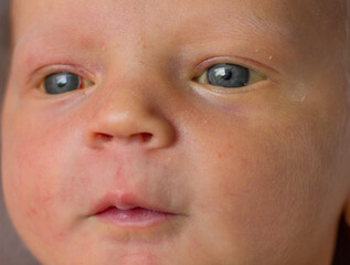 Neonatal jaundice - yellowish discoloration of the white part of the eyes and skin in newborn baby