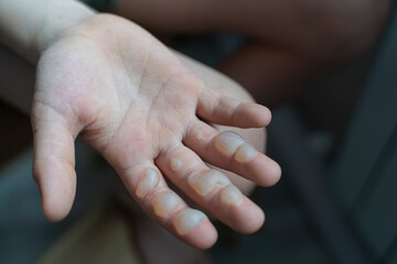 close-up of the child's brush. finger burn
