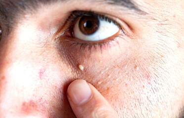 skin problem under the eyes