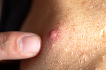 skin problem on the shoulder